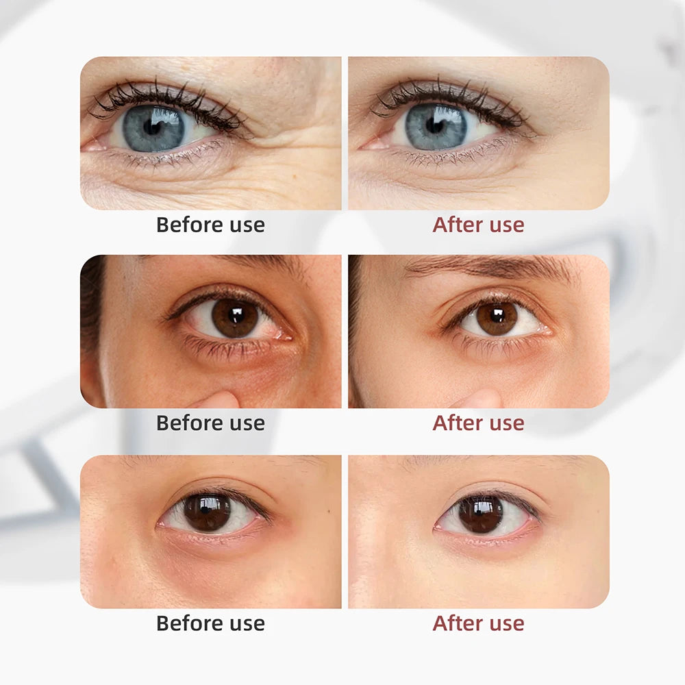Eye Beauty Device Eye Massager Eye Bag Removal
Anti Dark Circle Home Use Beauty Devices