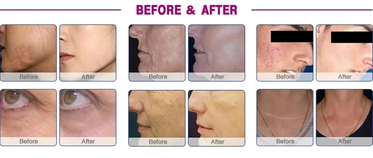CO2 Fractional Laser Machine Acne Scar Removal Skin tightening Remove wrinkles Vaginal rejuvenation beauty