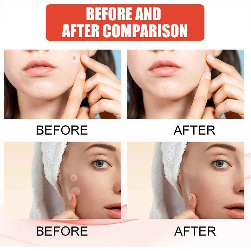 144pcs/set Face Skin Care Acne Pimple Patch 2 Sizes
Invisible Professional Healing Absorbing Spot Sticker