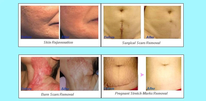 CO2 Fractional Laser Machine Acne Scar Removal Skin tightening Remove wrinkles Vaginal rejuvenation beauty